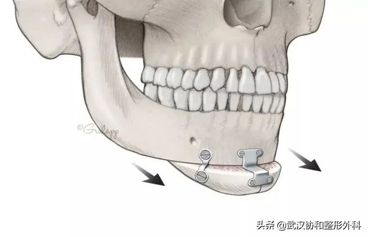 下巴整形有几种方式,下巴整形有几种办法