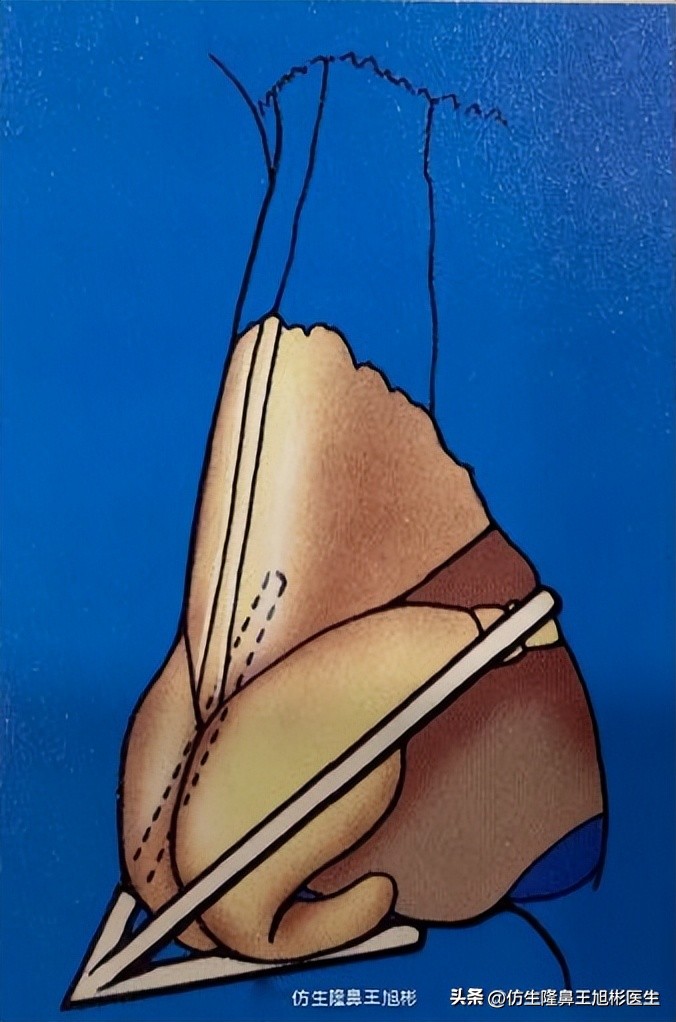 耳软骨隆鼻鼻小柱也是用耳软骨吗,耳软骨隆鼻可以摸到鼻尖的软骨吗