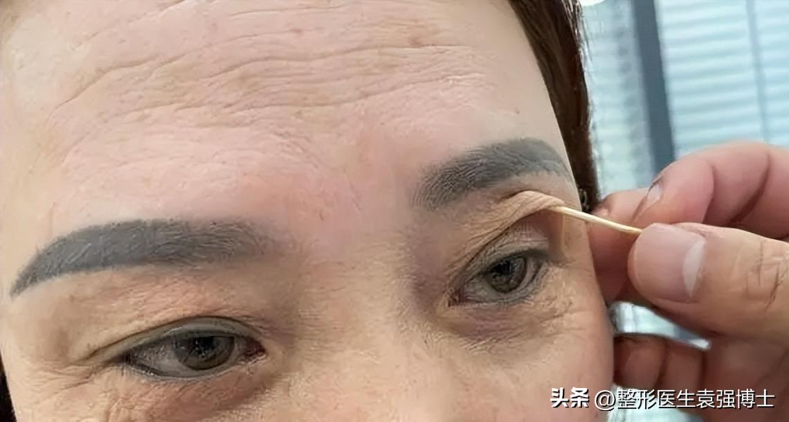 少年上眼皮松弛下垂的解决方法,年纪大眼皮下垂有什么好办法