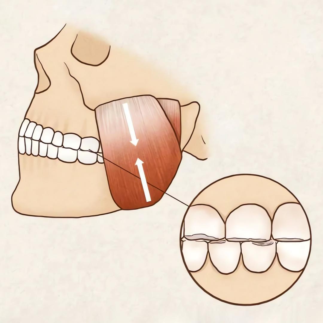 睡觉磨牙怎么治疗最有效,睡觉磨牙怎么治最快