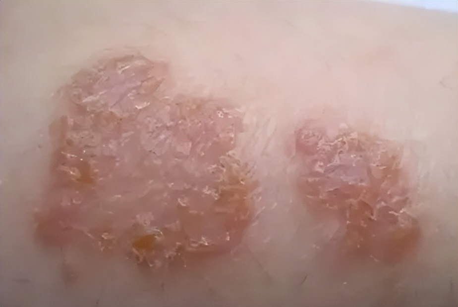 湿疹难耐远离湿疹从这四点做起,湿疹瘙痒难忍找对方法很重要