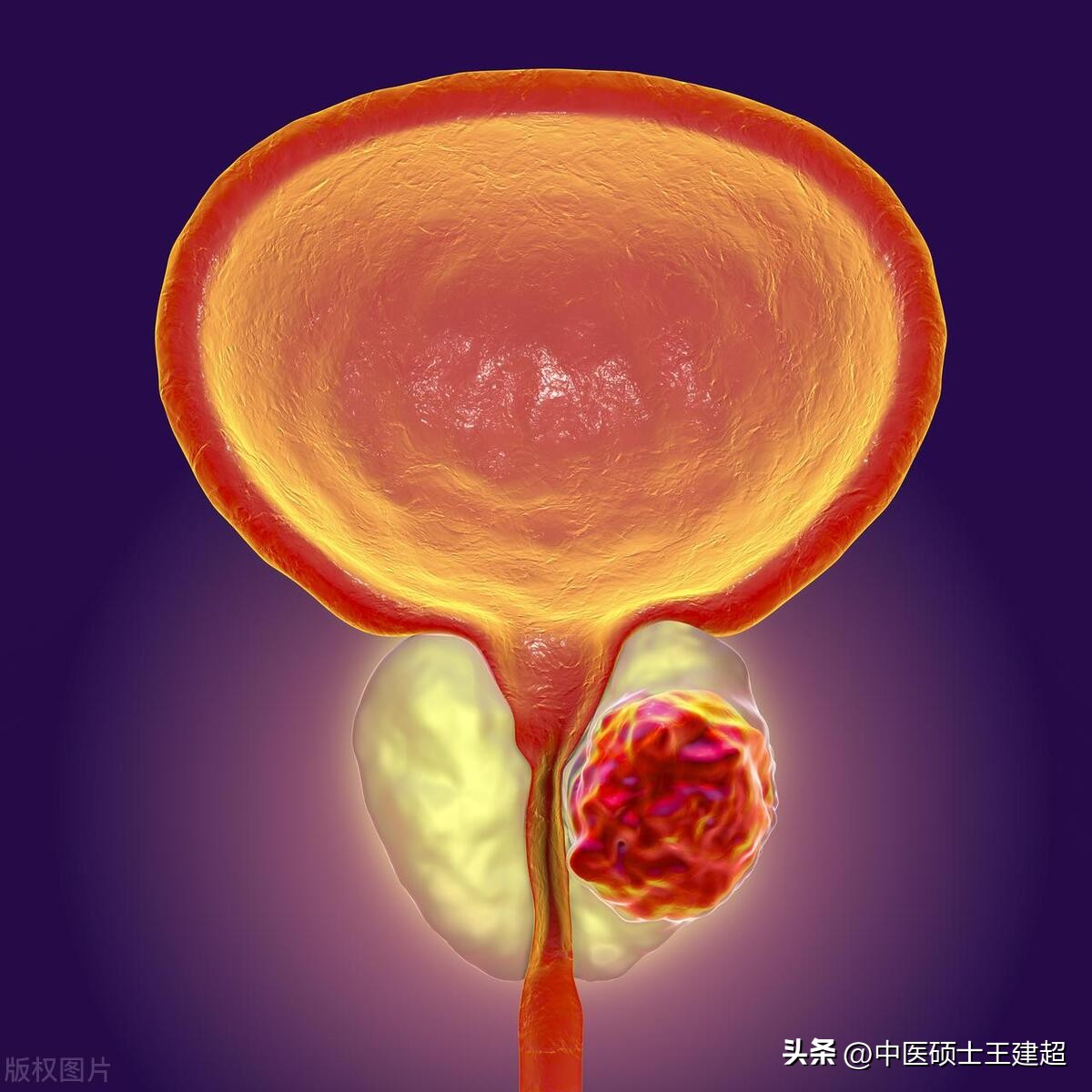 湿热下注到下肢吃什么中成药,湿热下注首先祛脾胃湿热