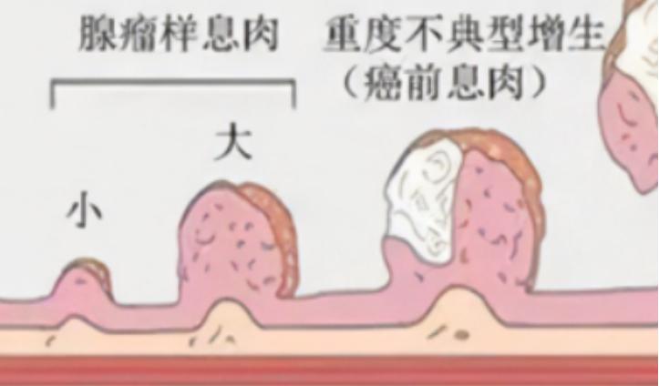 肠道多发息肉还是单发息肉严重,肠道扁平息肉厉害还是息肉厉害