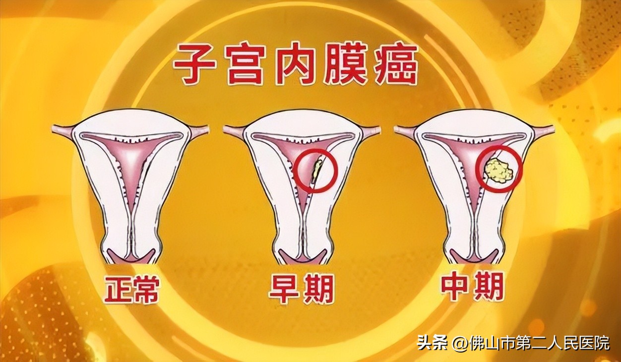 关爱女性健康非经期出血,关爱女性宫腔健康