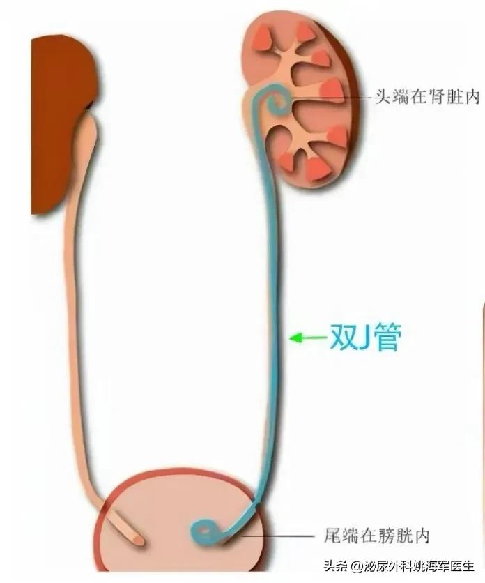 尿路结石术后留置管的作用,尿路结石微创手术前为何要留管