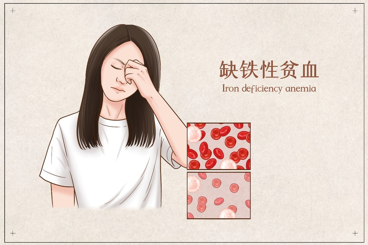 肾病缺铁性贫血怎么补,男性缺铁性贫血怎么补