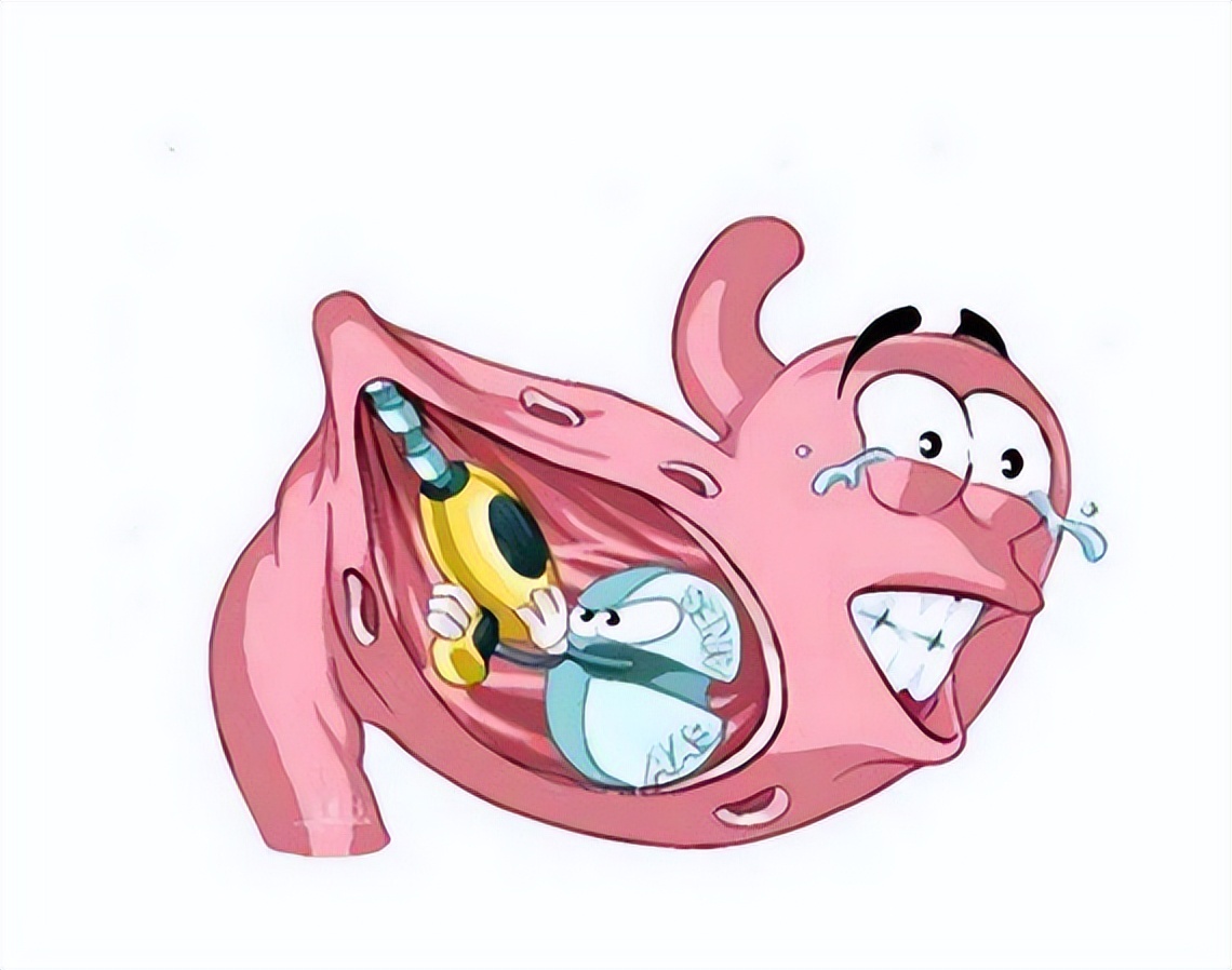 带你了解你的肠胃,胃穿孔科普知识