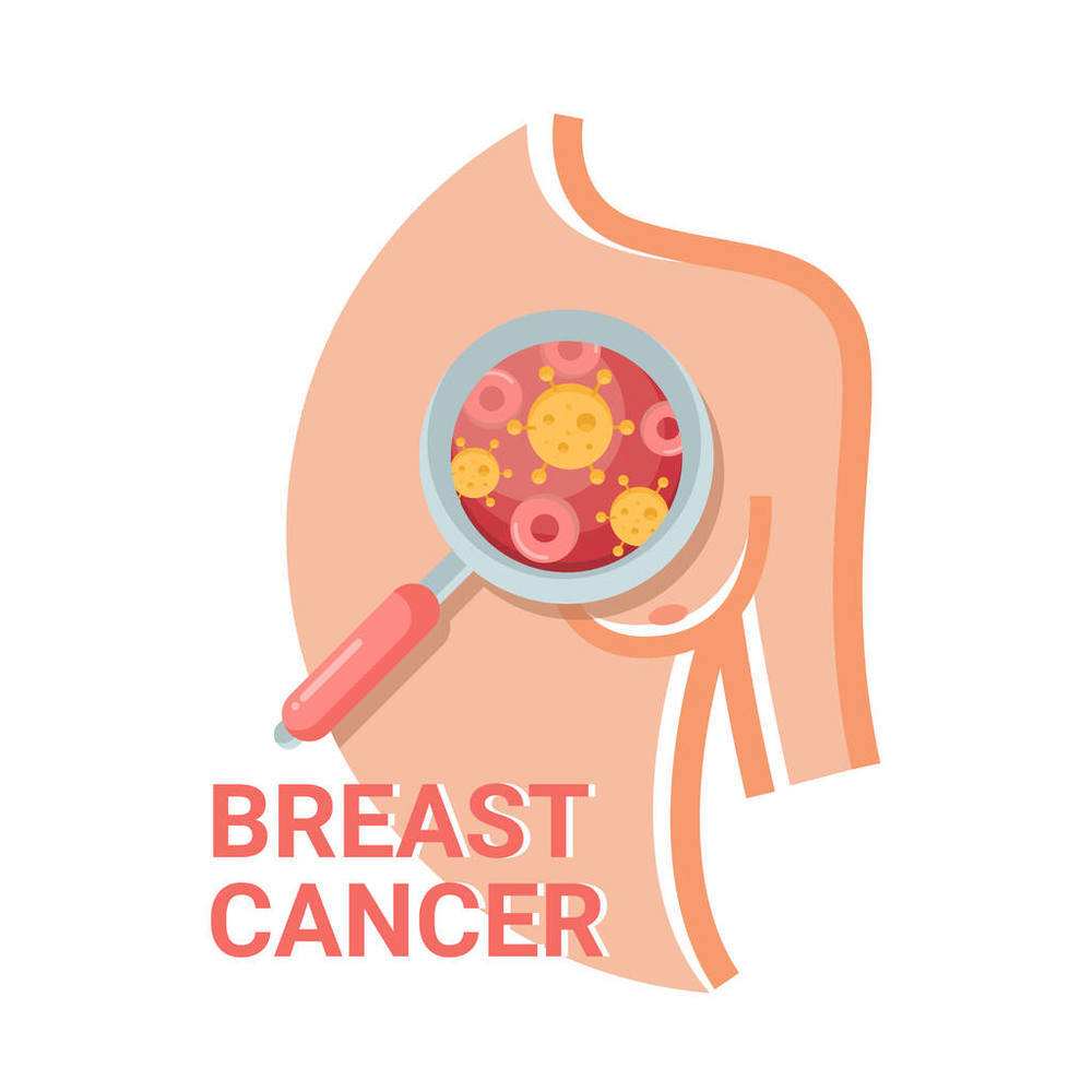 乳腺导管原位癌her2阳性如何治疗,乳腺导管原位癌微浸润治疗