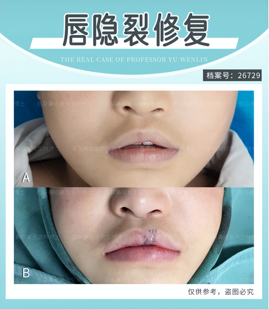 唇裂鼻畸形一期,隐形唇裂会越来越严重吗