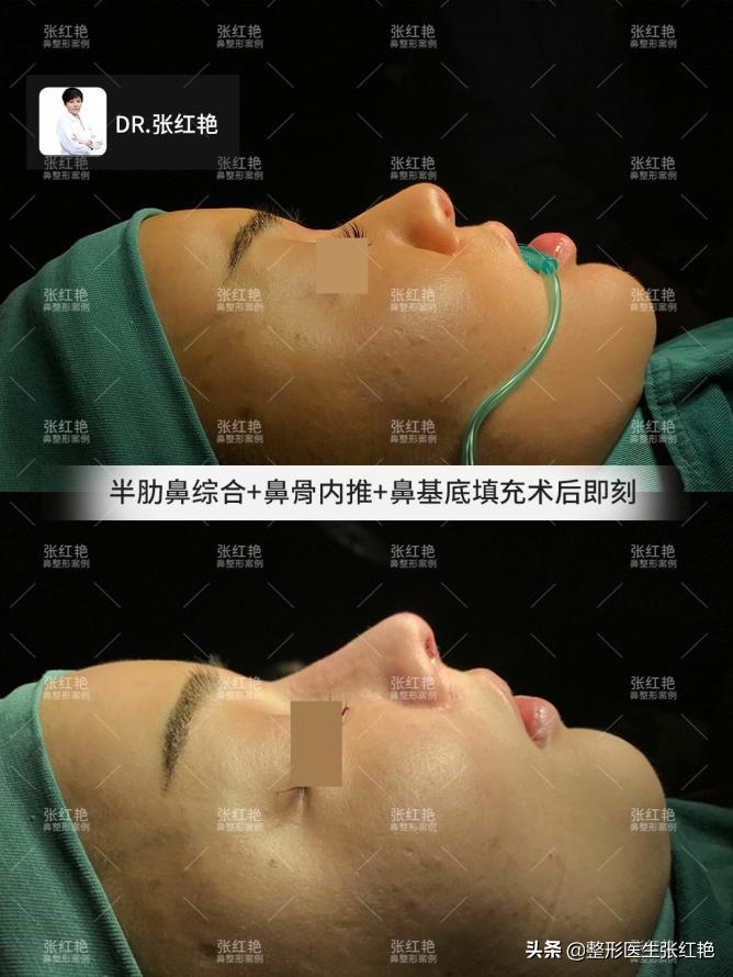 鼻额角怎么做比较有弧度,转折明显的鼻额角好看吗