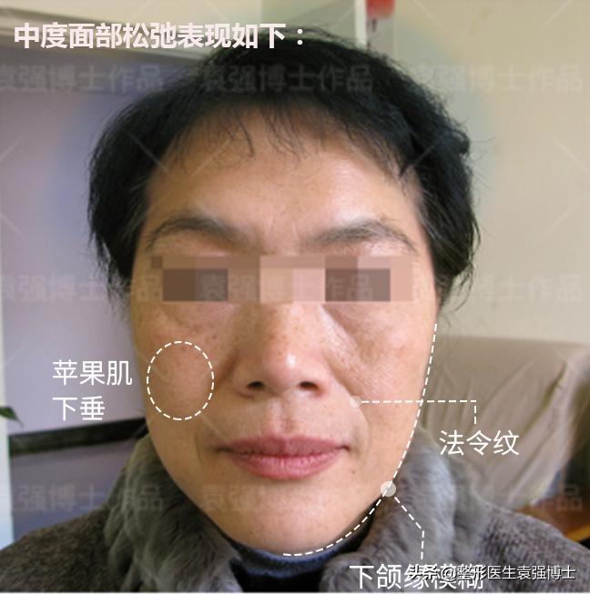 小切口面部提升能维持多久,面部提升的穴位手法完整视频