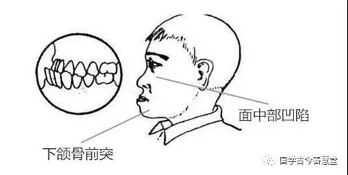 易经噬嗑白话解释,易经噬嗑卦啥意思