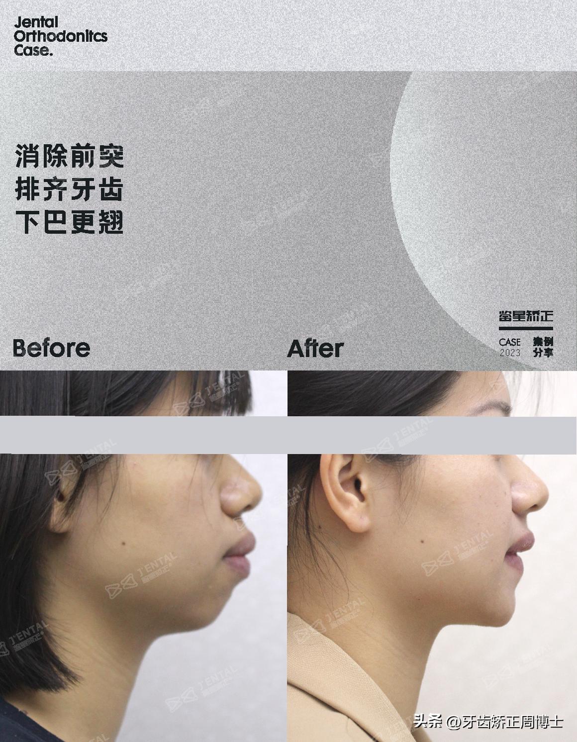 骨性上颌前凸嘴怎么矫正,厚嘴唇与嘴凸有关吗