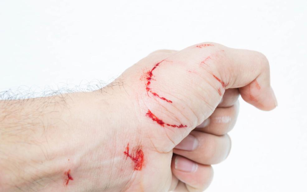 小伤口特别疼要怎么办,小伤口别大意