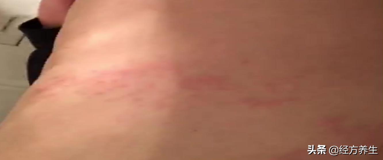 手指湿疹合并汗疱疹,湿疹和疱疹同时有怎么治疗