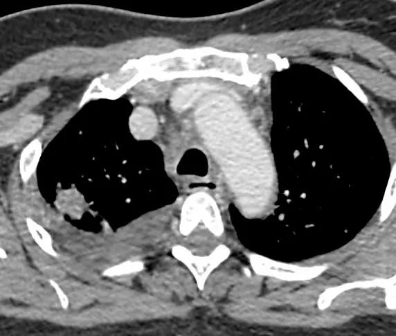 肺癌egfr阳性吃靶向药能活几年,肺癌靶向治疗基因检测egfr