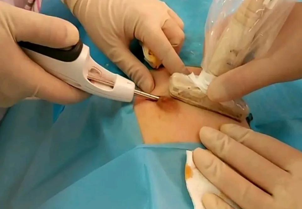 乳腺结节手术及恢复是全过程,乳腺结节微创手术治疗的过程