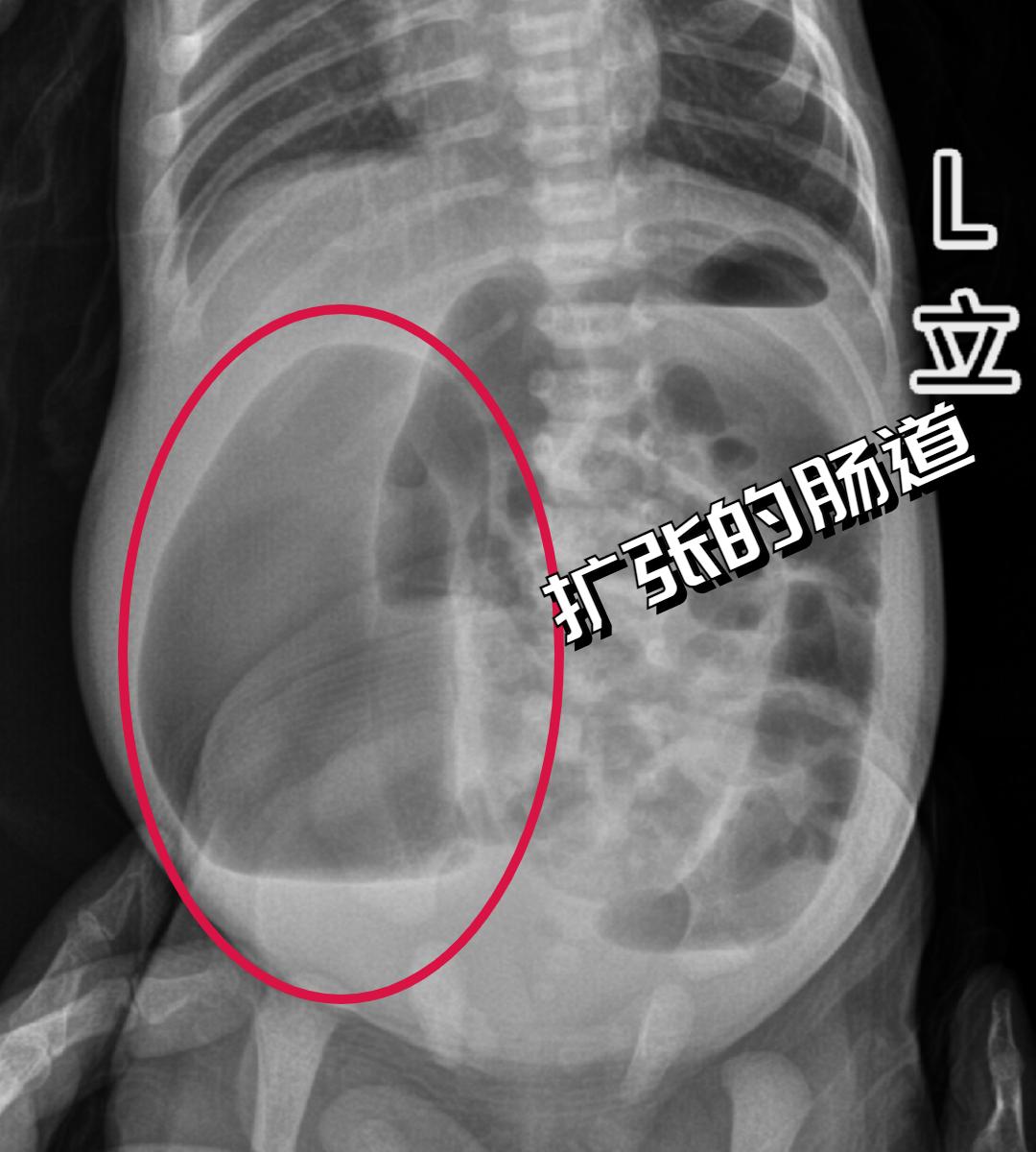 30天的小孩子肚子鼓鼓的硬硬的,儿童肚子胀得像大气球