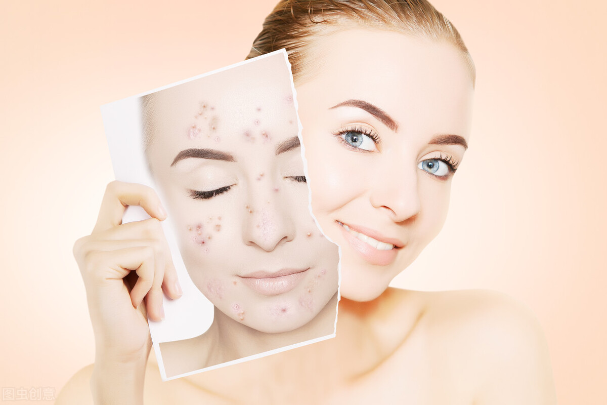 为什么脸上会长青春痘,少年脸上长了好多青春痘怎么办