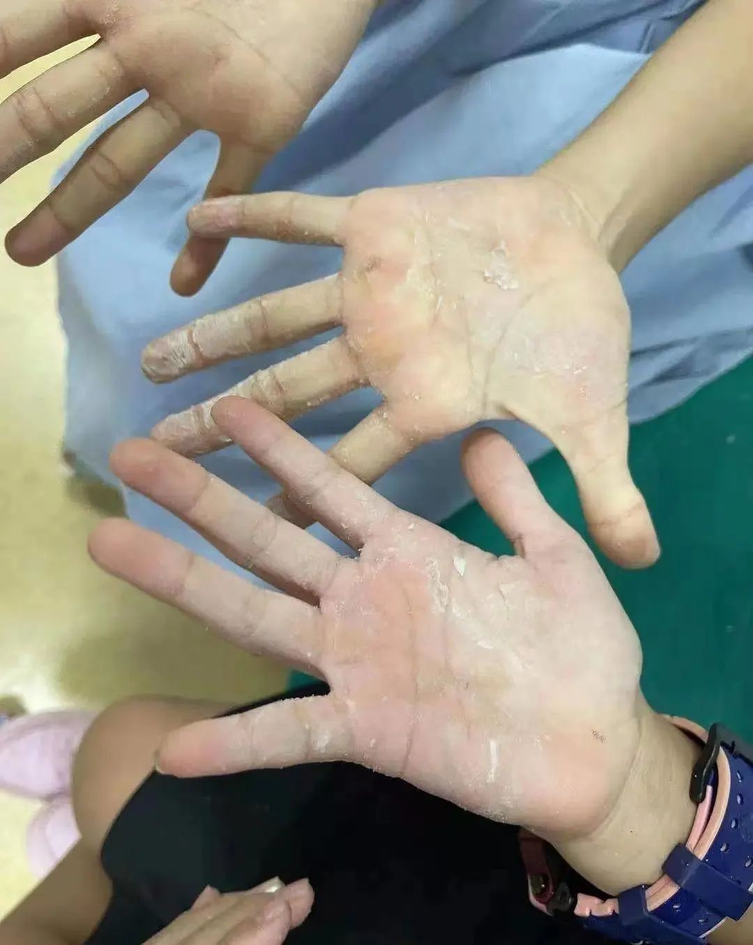 502不小心溅到眼睛里了怎么办,502溅了一点点进眼睛里了怎么办