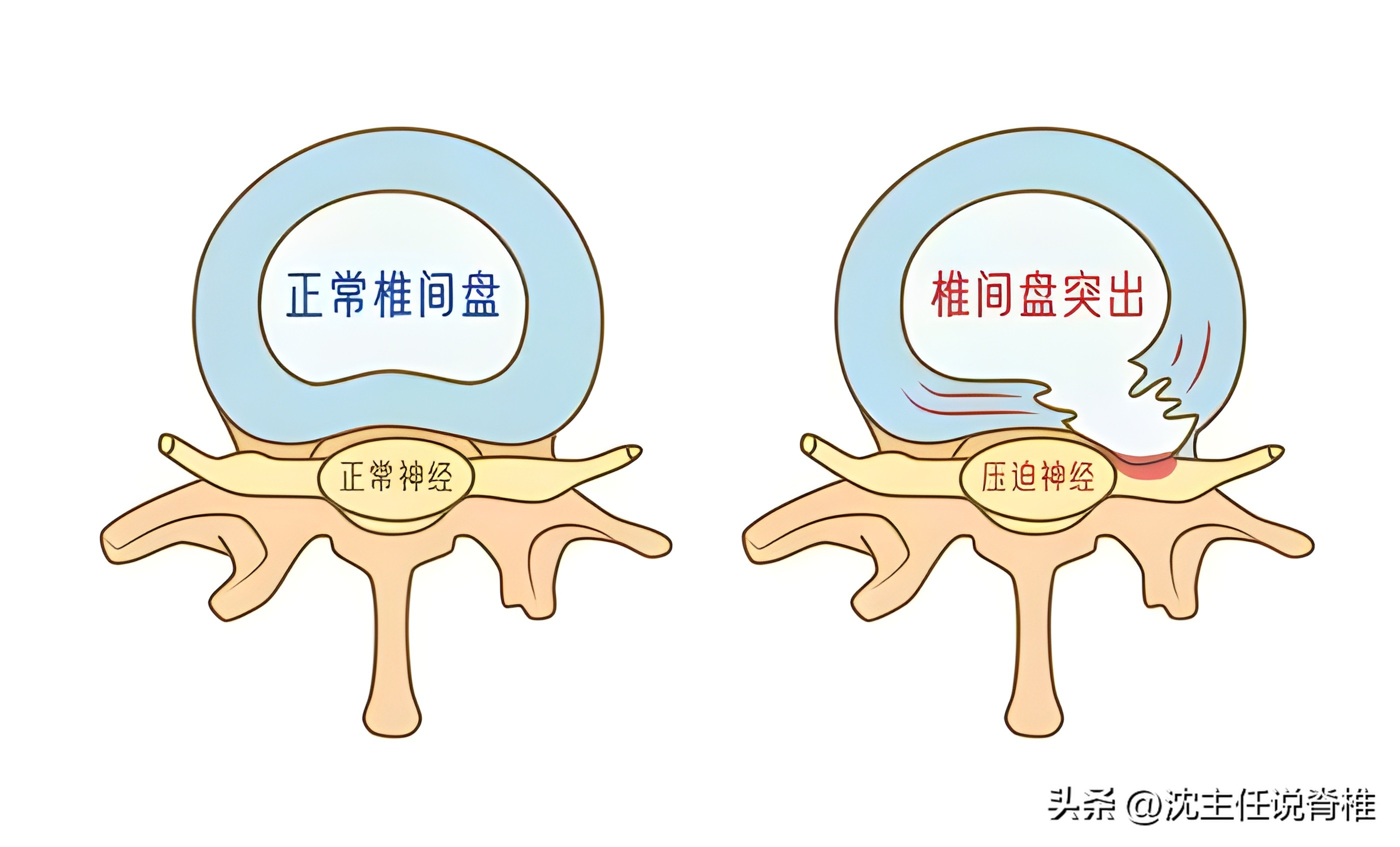 腰椎间盘突出臀部肌肉减少怎么办,腰椎间盘突出引起臀部痛如何治疗