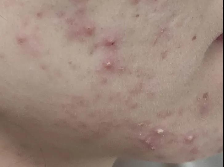 问题肌36计:4大级别痘痘如何对抗你知道吗?调理代谢很重要