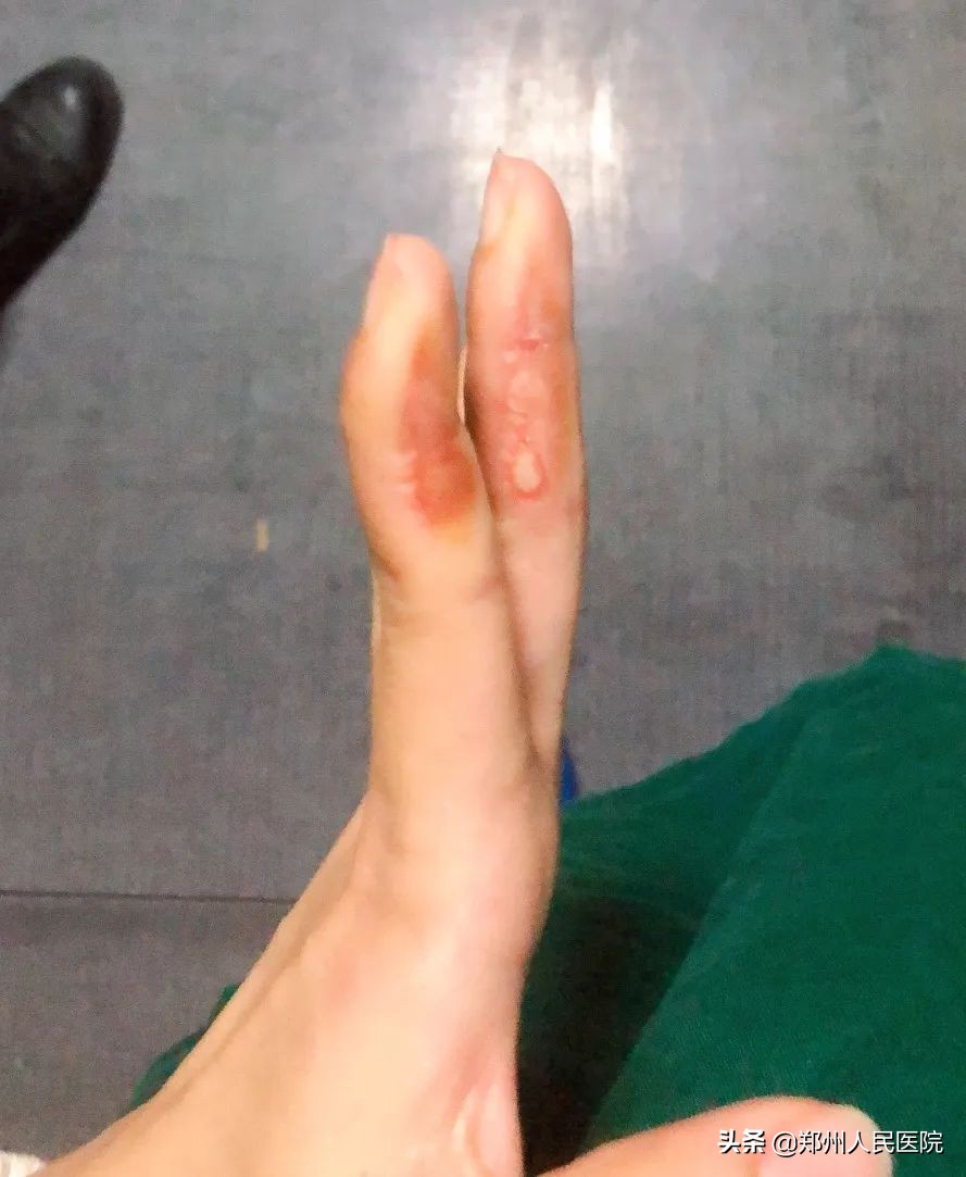 手指烫伤流脓依然坚守一线！小编带你一起到太康“云探班”