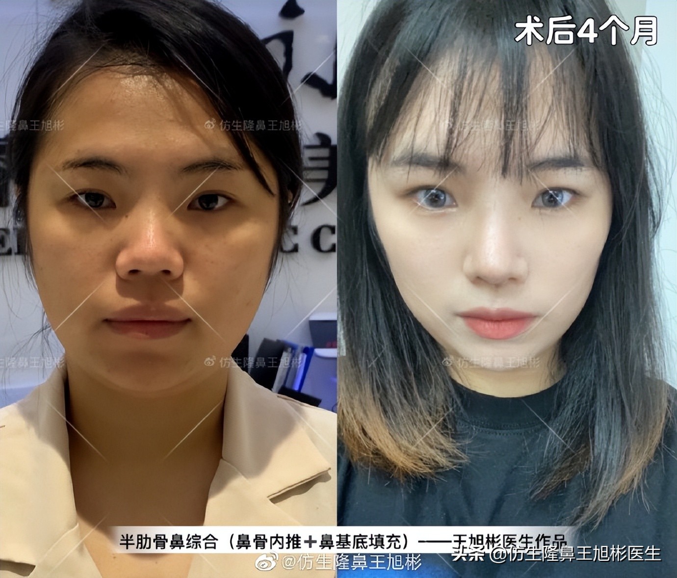 做一次鼻头缩小要多少钱好,可以只做鼻头缩鼻翼吗