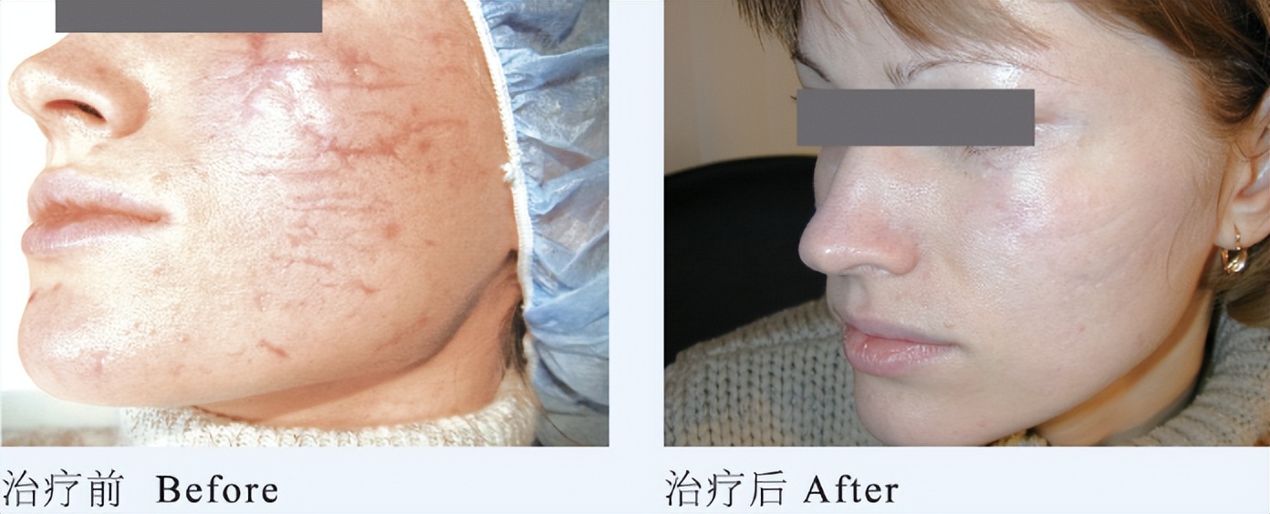 青春痘逆袭的方法,16岁青春期学生痘印如何改善