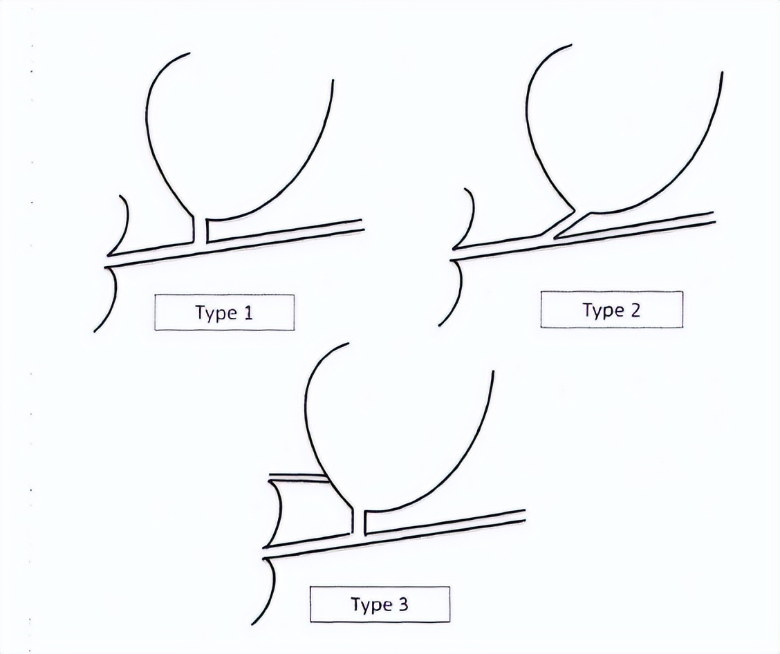胰胆管合流异常影像诊断,基于影像组学的深度学习