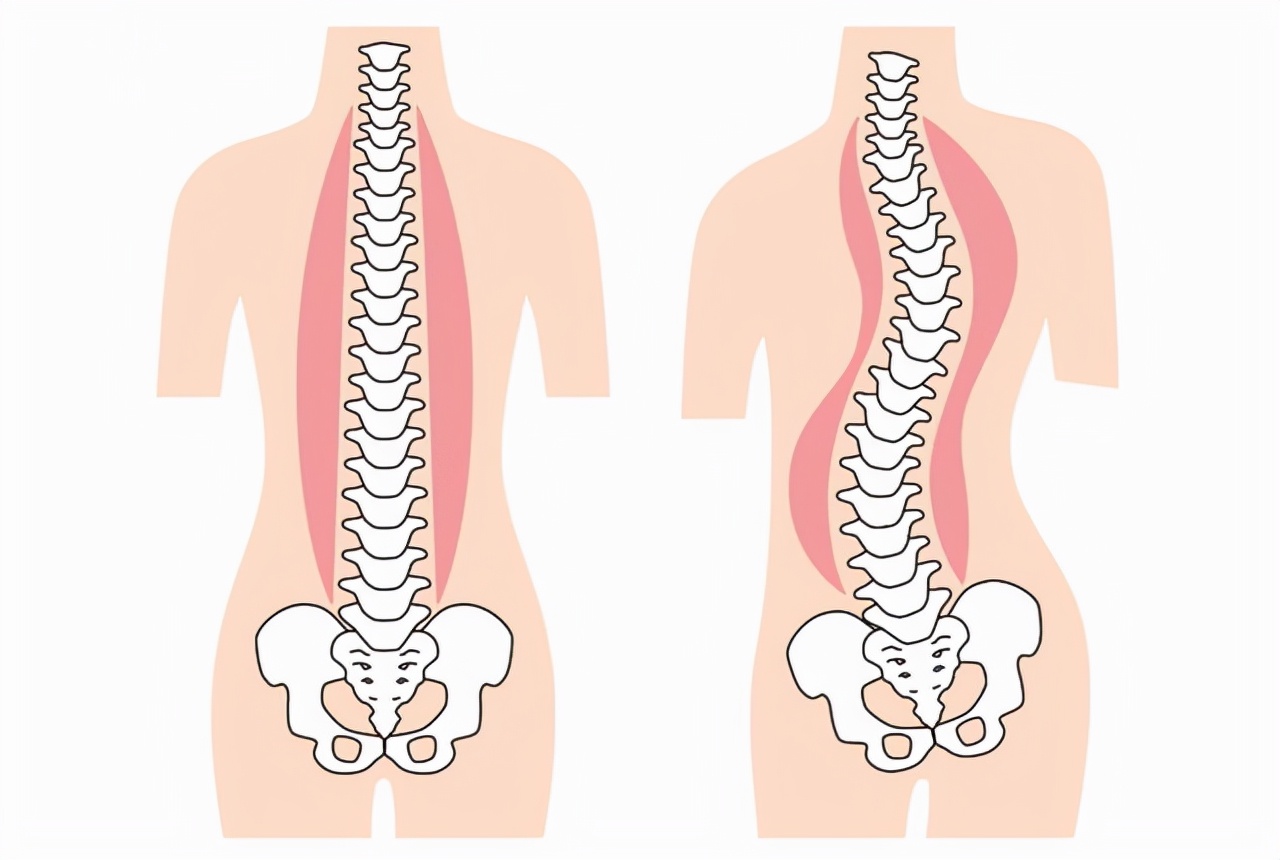 脊柱侧弯保守治疗可以报销吗,脊柱侧弯手术15万能报销多少