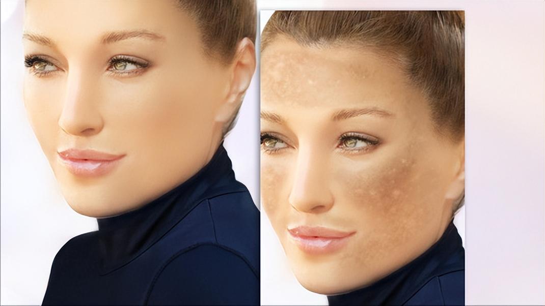 红霉素软膏可以治疗手上老年斑,红霉素软膏可以去除老年斑么