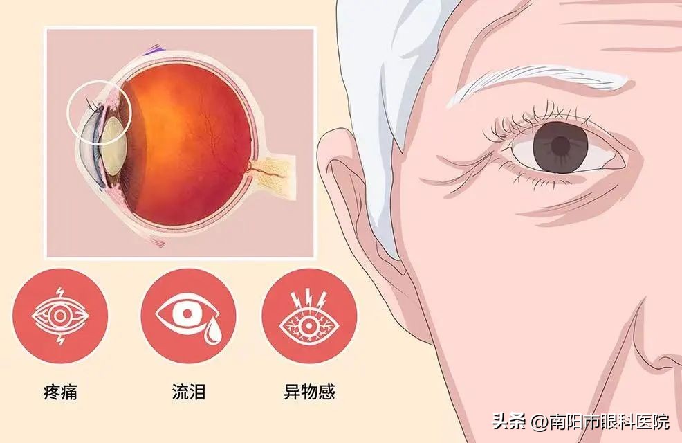眼睛下睑内翻该咋治疗,眼睛轻微睑内翻