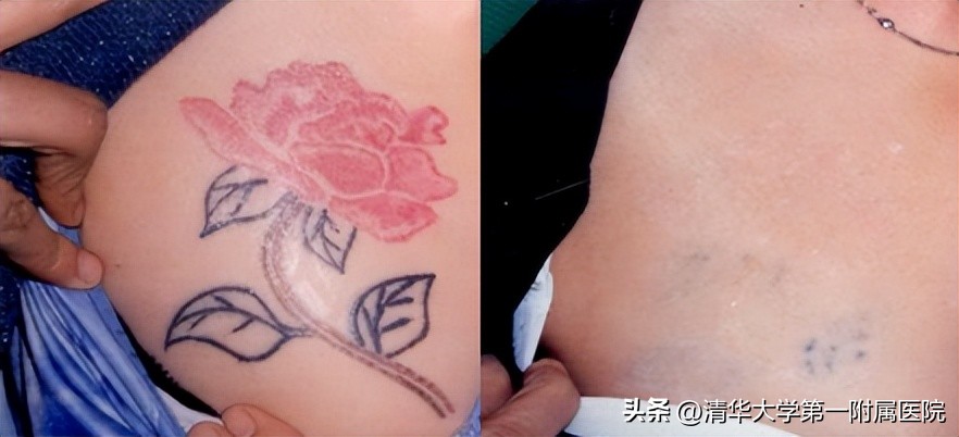 来深度了解皮秒激光美白祛斑效果,皮秒激光美白嫩肤祛斑紧肤