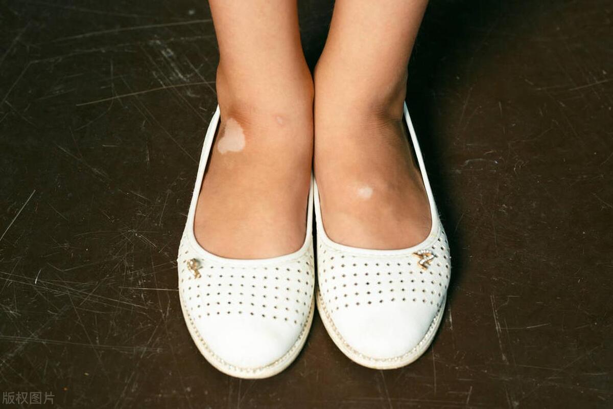 白癜风如果不治疗有什么后果,白癜风拖着不治疗的危害