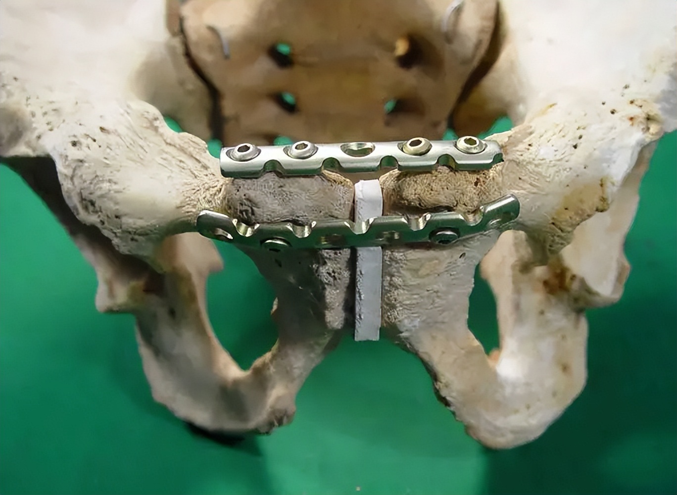 骨盆后环损伤后，新型螺钉的不同内固方法各有何优势？哪种方法好