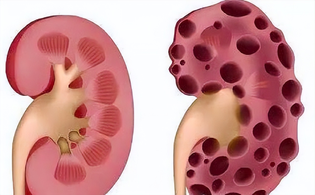 中医治疗多囊肾最新治疗方法,男性多囊肾有什么症状