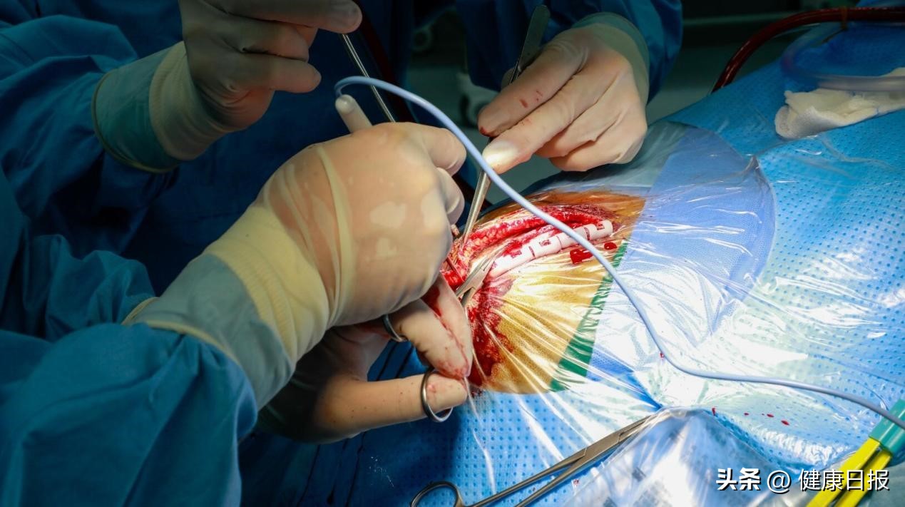 云开“雾”散联合血管重建术消弭烟雾病烦扰，专家：反复脑“中风”，可能是烟雾病放出的“烟雾弹”