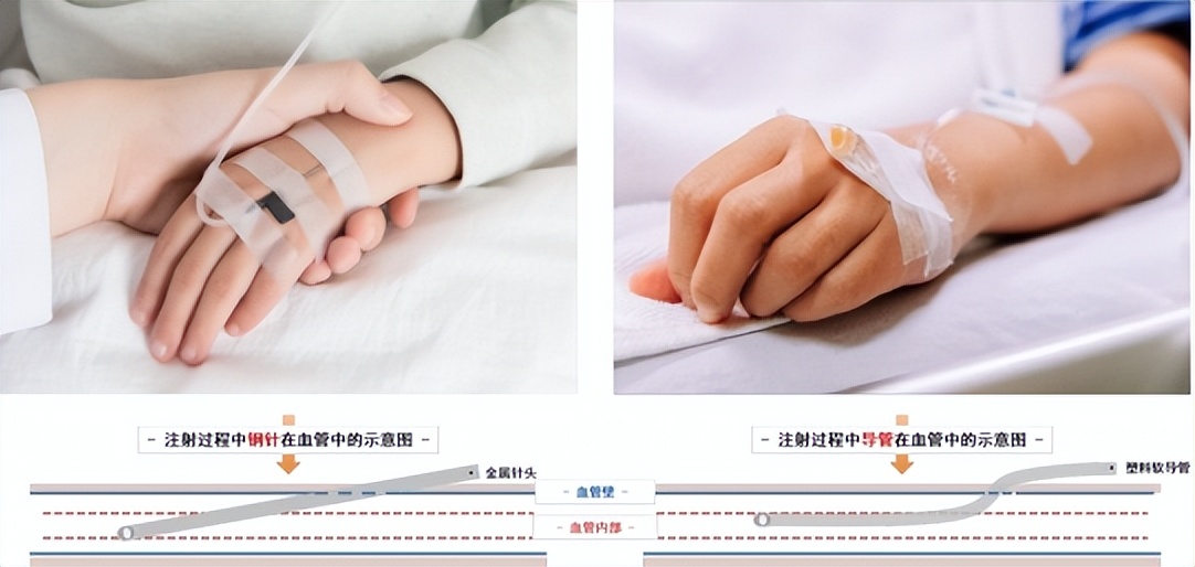 输液时留置针和钢针的区别,小儿留置针输液视频教程