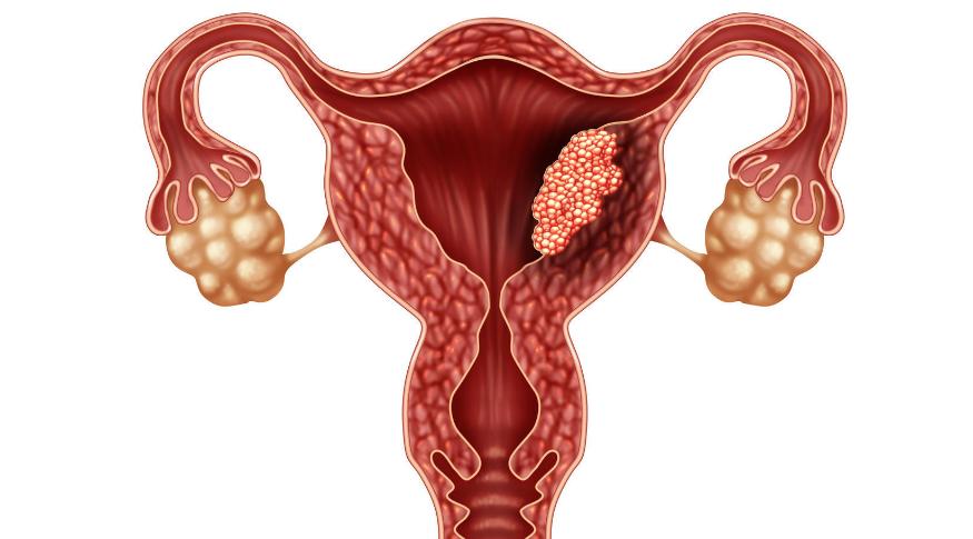 子宫癌早期的三种症状,子宫癌早期10种症状