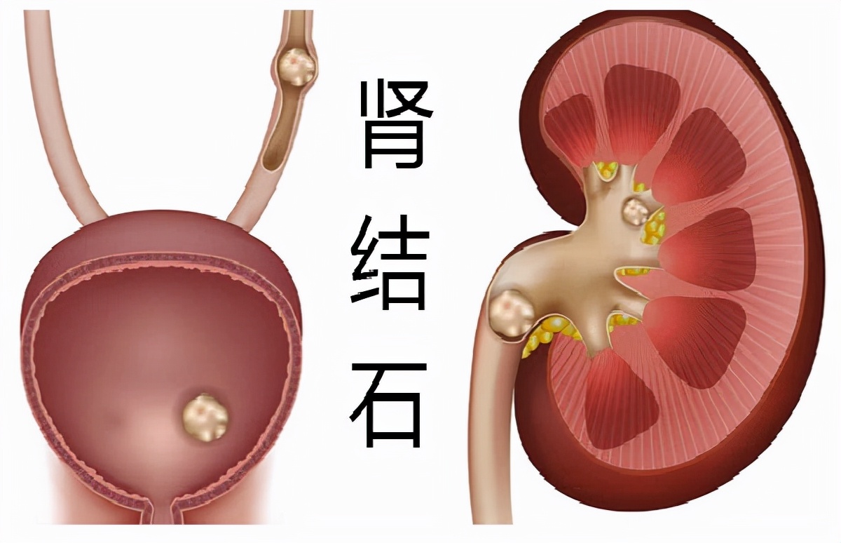 女子肾结石不痛十余年后一个肾坏死，结石如何伤肾？中医治疗方法