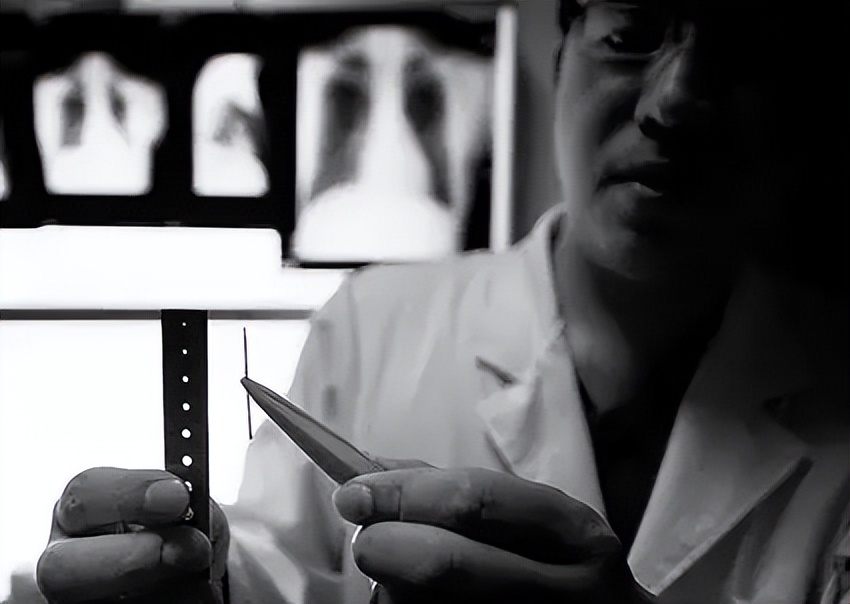 山西3针治疗精神分裂症,催眠术治精神分裂症