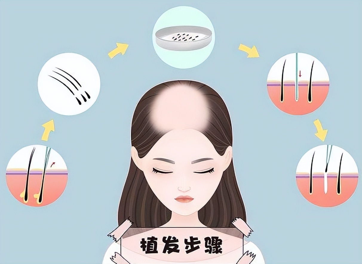 植发后水肿是什么原因,植发后水肿吃哪个消炎药好