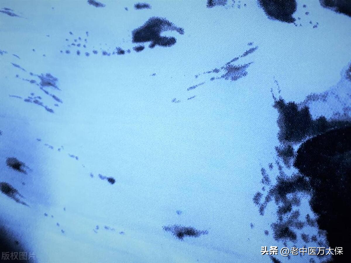 磨玻璃肺结节25mm是肺癌早期吗,磨玻璃结节中医调理能否治愈消失