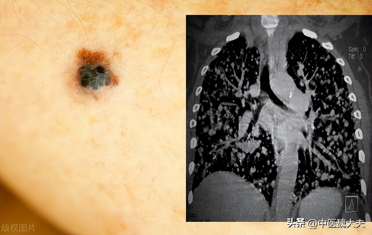 身上长这种颜色的痣要当心癌症,痣越长越大就是癌症的可能吗