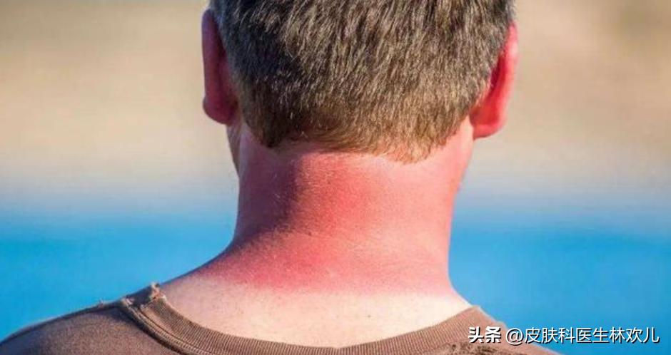 【日光性皮炎攻略】夏天想去海滩晒阳光浴？教你如何保护好自己！