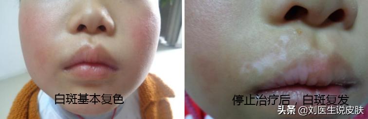 白癜风怎么彻底治愈,白癜风怎么快速治