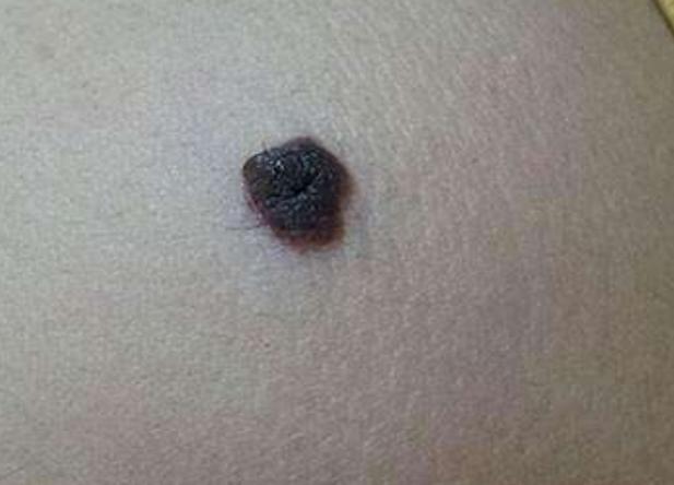 切肤之爱真实上演，河北妈妈割皮救子，就算割光全身的皮也不怕