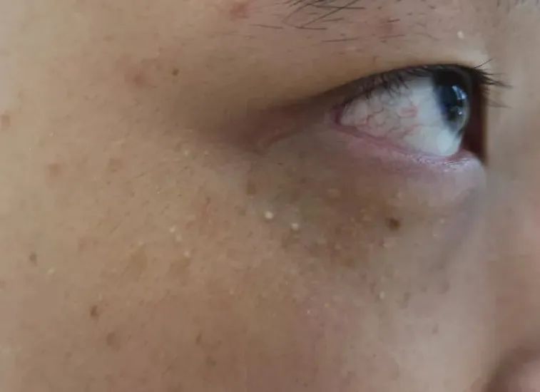 hpv病毒引起的疣是什么,hpv引起的病毒疣