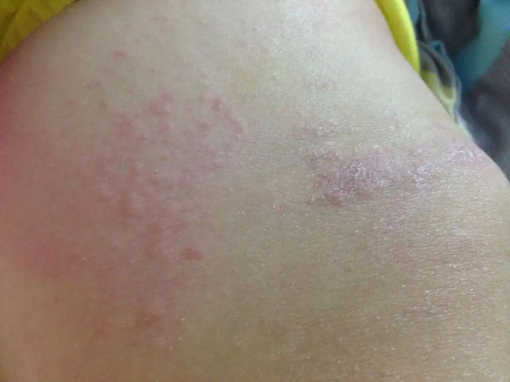 每到秋天，手和腿上就会出现各种干燥情况，还会脱皮，要怎么办？